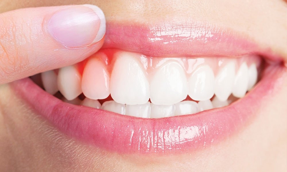 Diş Eti Hastalıkları